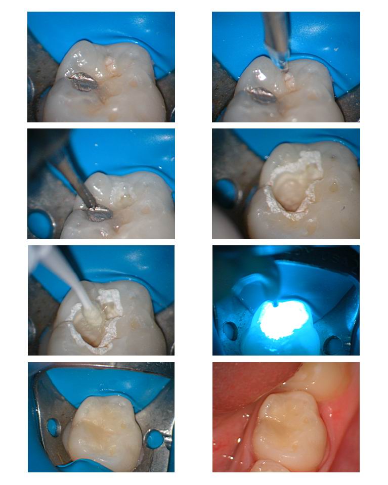 Class 1 with amalgam removal.jpg